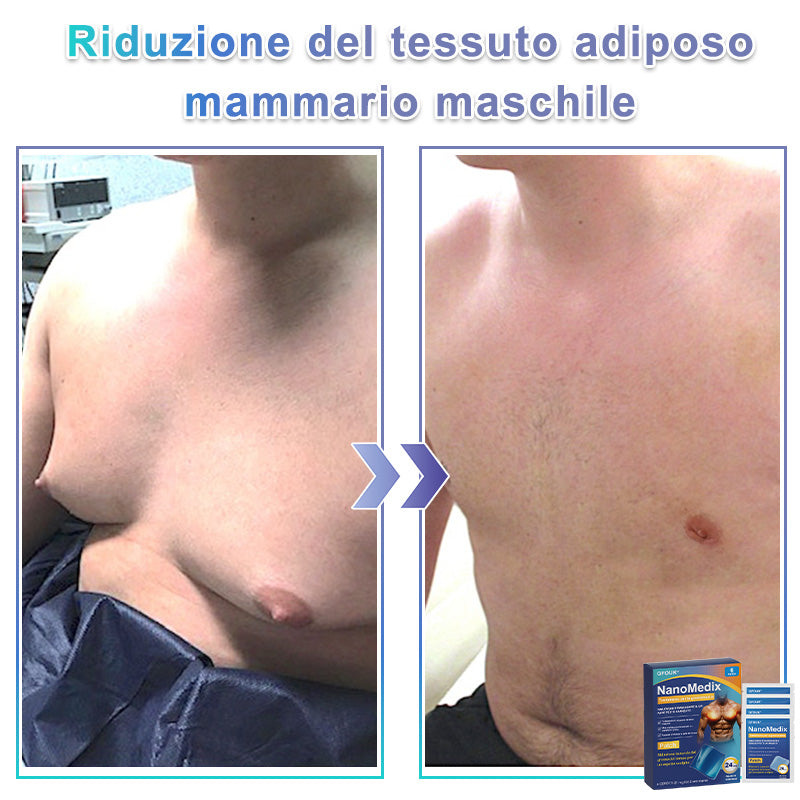🌊GFOUK® NanoMedix Patch Ginecomastia - Azione Brucia Grassi e Tonificante