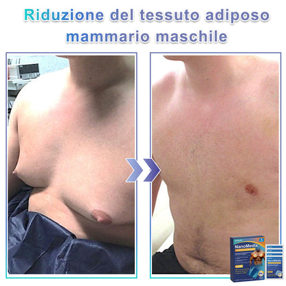 🌊GFOUK® NanoMedix Patch Ginecomastia - Azione Brucia Grassi e Tonificante