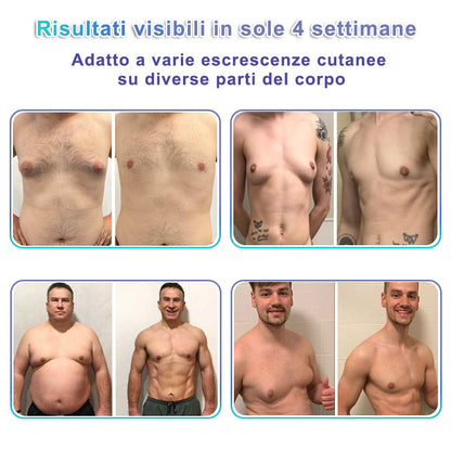 🌊GFOUK® NanoMedix Patch Ginecomastia - Azione Brucia Grassi e Tonificante